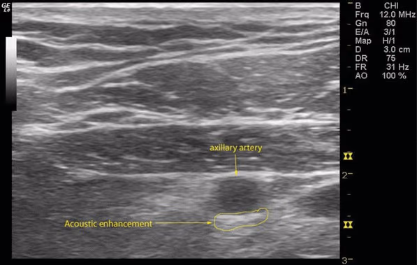 Ultrasound of the axillary artery showing acoustic enhancement