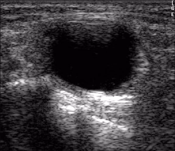 Fluid-filled cyst with increased echogenicity posterior to it