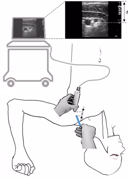Diagram of the ultrasound screen, probe and needle aligned along one line of sight